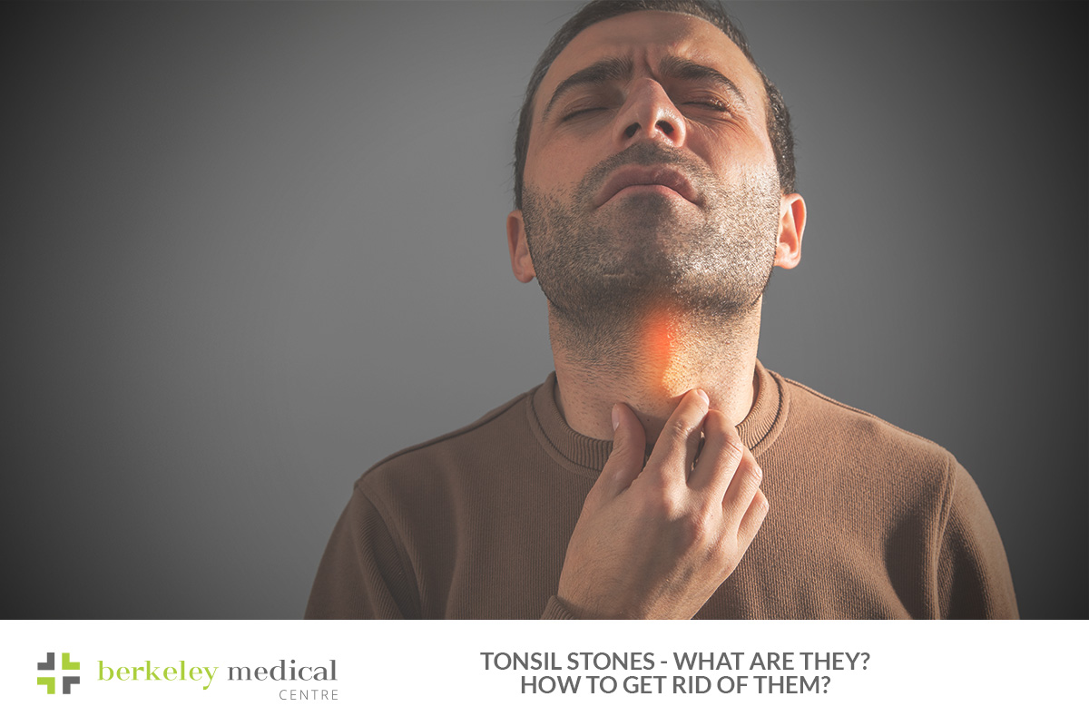 Tonsil Stones: What They Are and How to Get Rid of Them