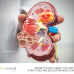 Kidney Stones
