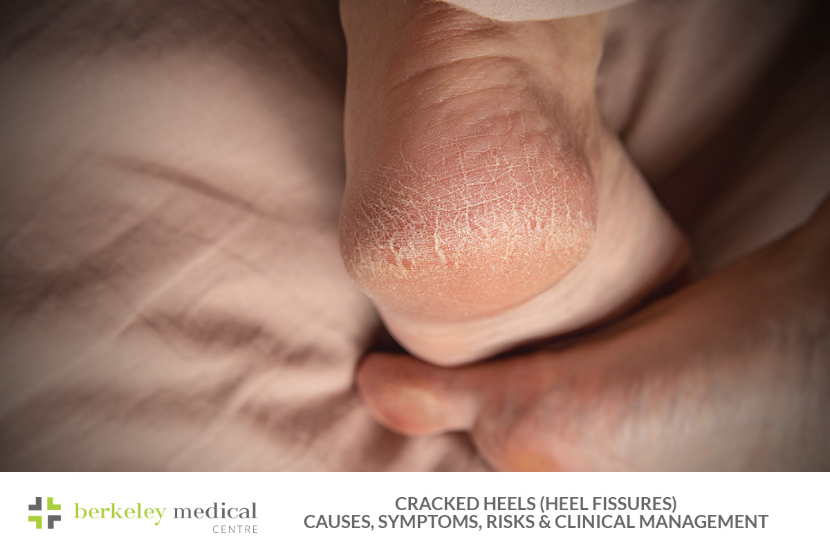 Cracked Heels (Heel Fissures)